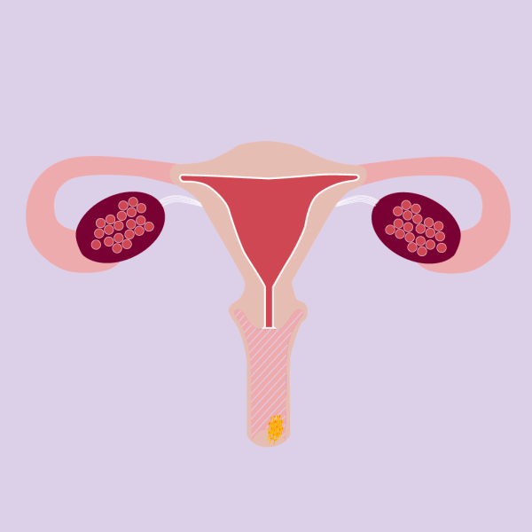 Animation demonstrates how ellaOne protects the egg from fertilization